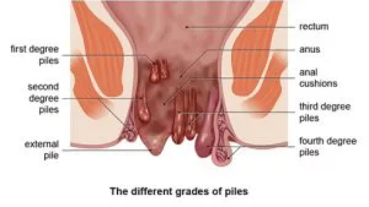 Ayurvedic Treatment for Piles - Types, Causes, Signs & Remedies